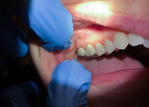 Best Broken or Cracked Tooth Emergency Dentist in Westport, NC